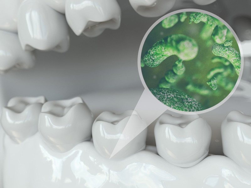 Dental Implants Complications