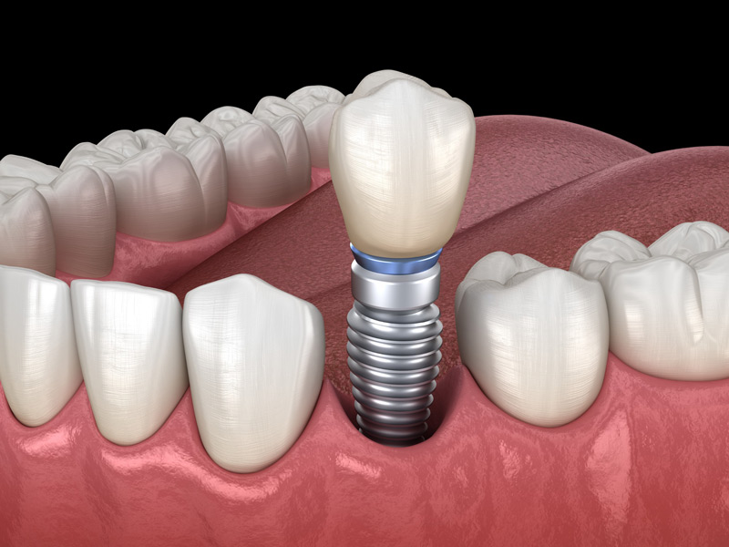 Dental Implant Aftercare: Tips for a Successful Recovery